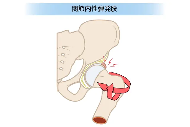 関節内性弾発股