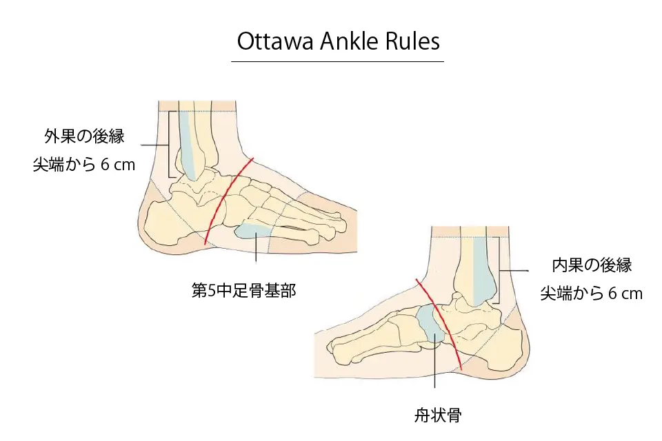 オタワアンクルルール