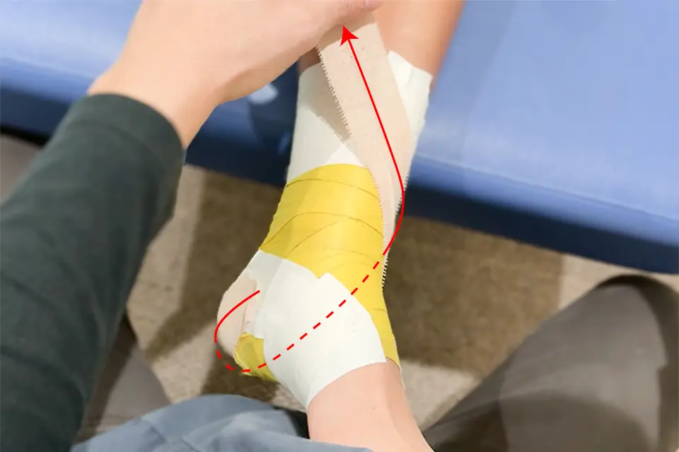 足関節捻挫のテーピング（踵骨内反制動テープ１）