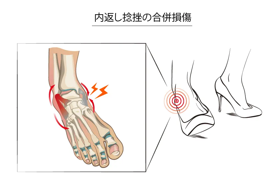 内反捻挫の合併損傷