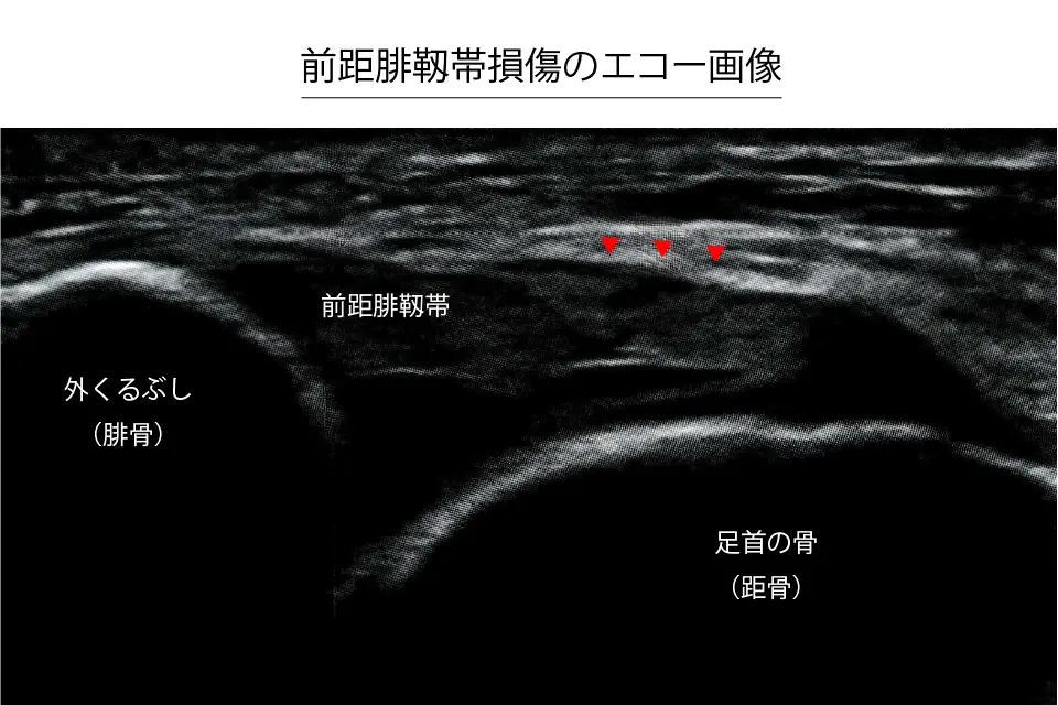 前距腓靭帯損傷のエコー画像