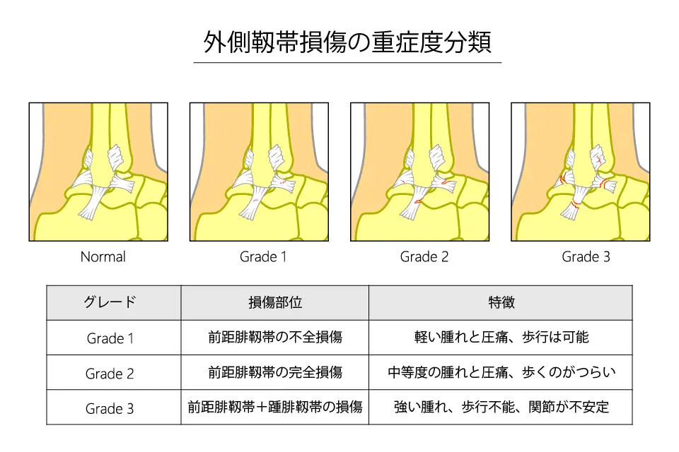 外側靱帯損傷の重症度分類