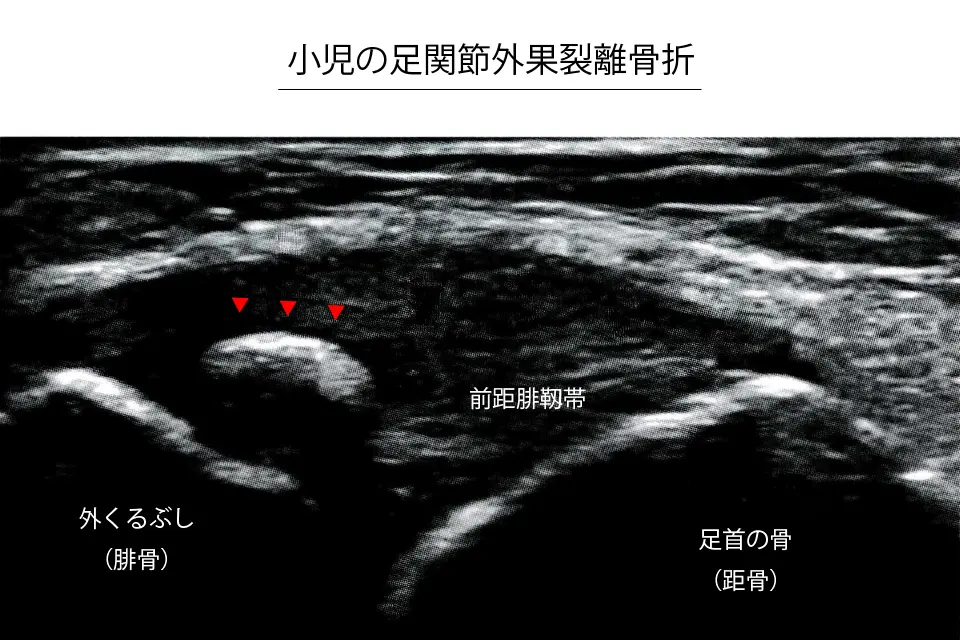 小児の足関節外果裂離骨折のエコー