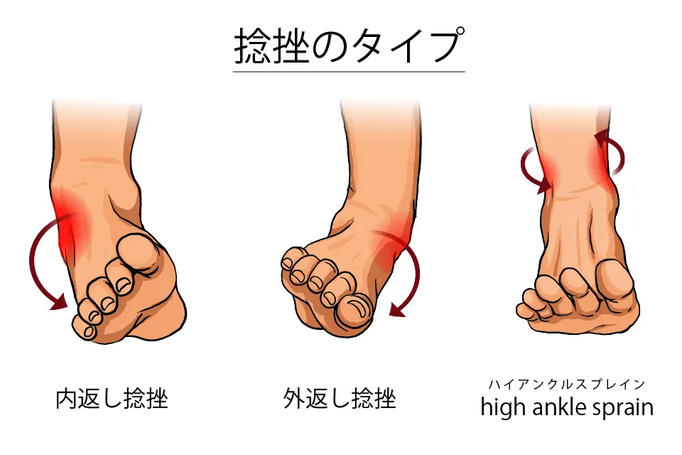 捻挫のタイプ
