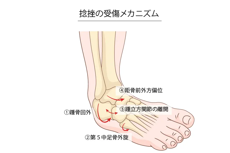 捻挫の動体