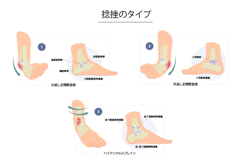 足関節捻挫のタイプ