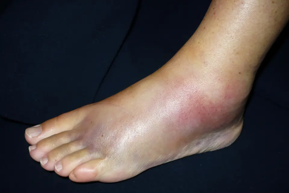 足関節捻挫後の腫れ