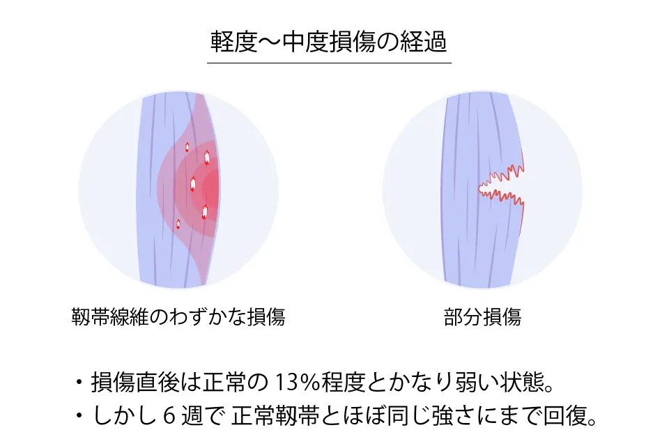 軽度〜中度の靭帯損傷の経過