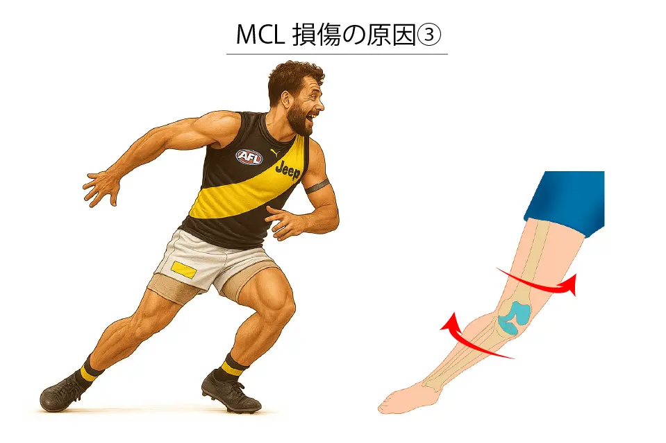 MCL損傷の原因③