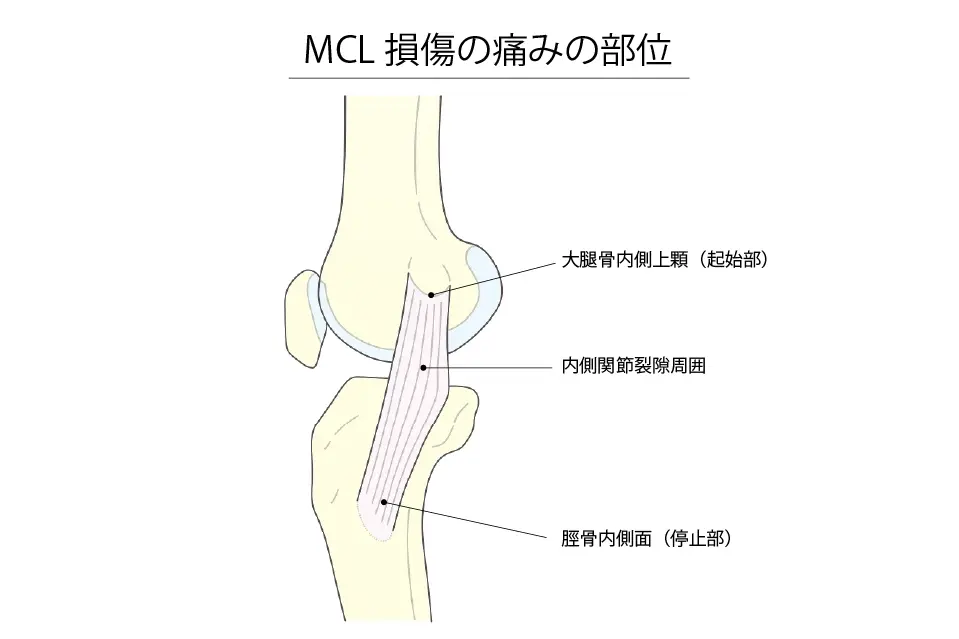 MCL損傷の痛みの部位