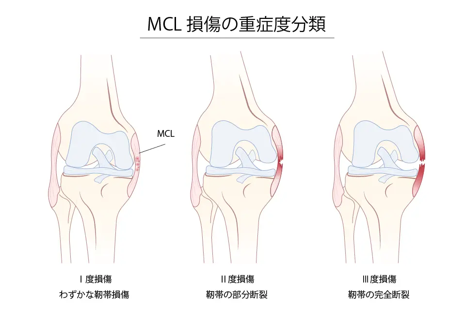 MCL損傷の重症度分類