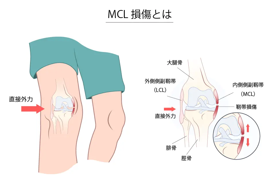 mcl損傷とは