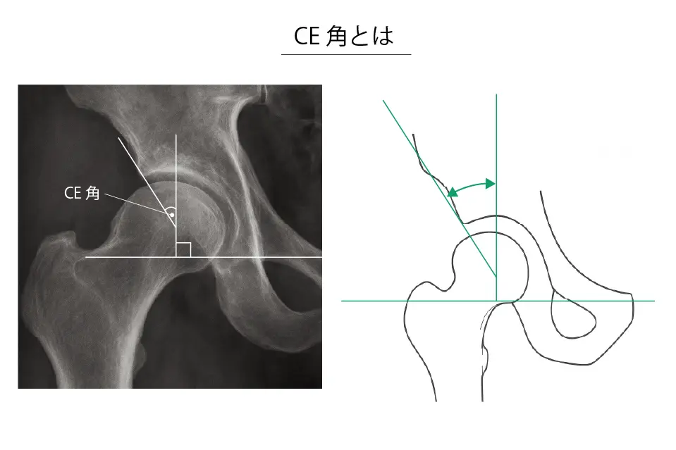 CE角とは