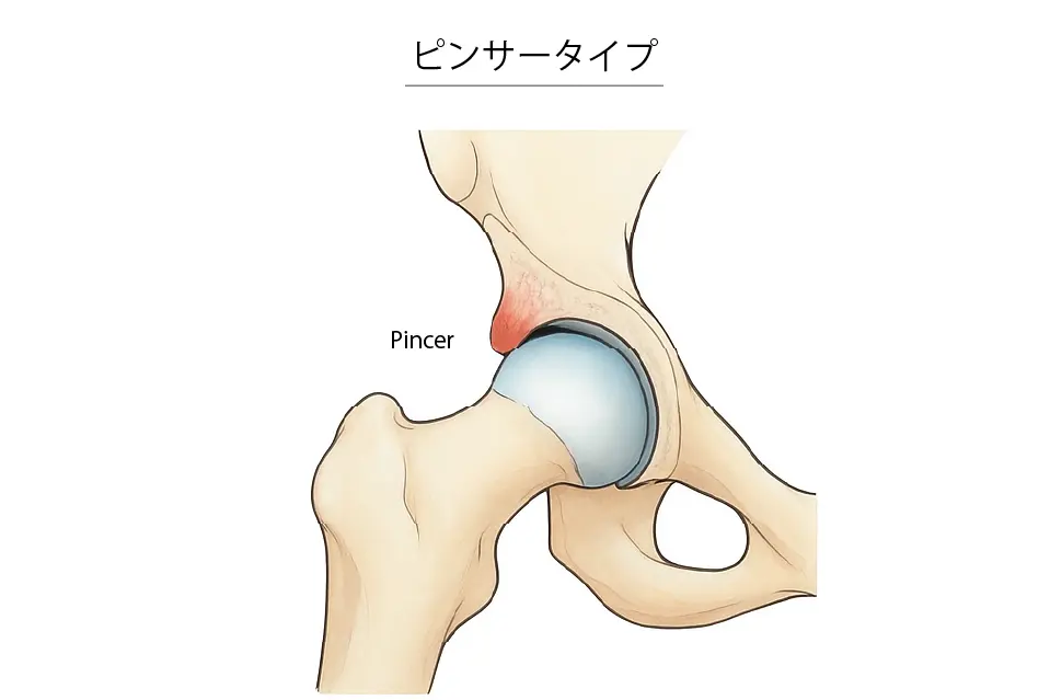 FAI（pincer type）