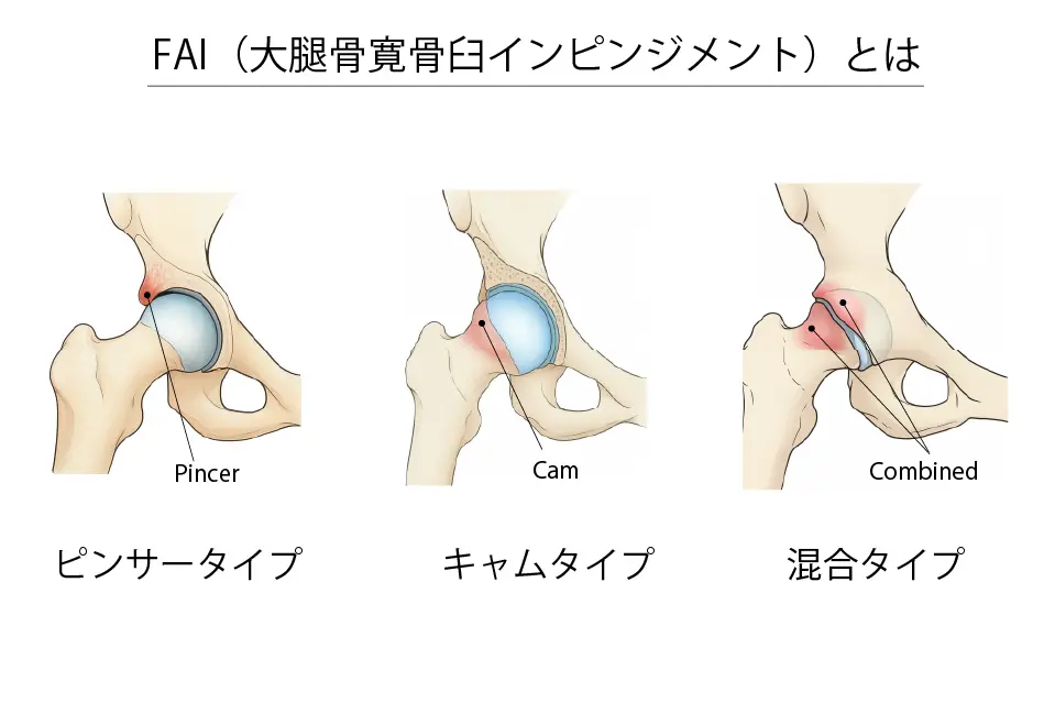 FAI（大腿骨寛骨臼インピンジメント）とは