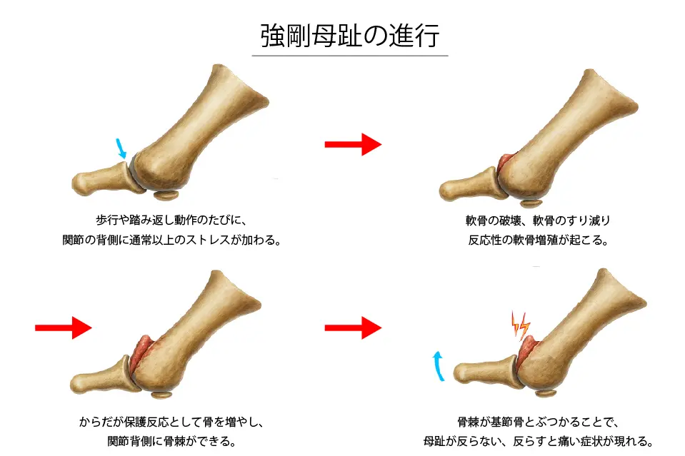 強剛母趾の進行