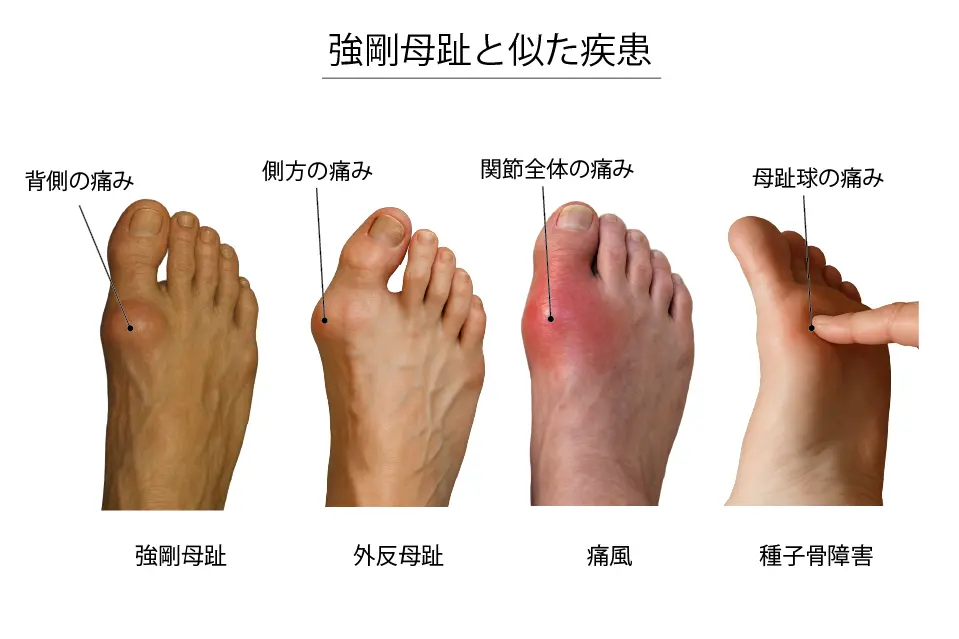 強剛母趾の鑑別疾患