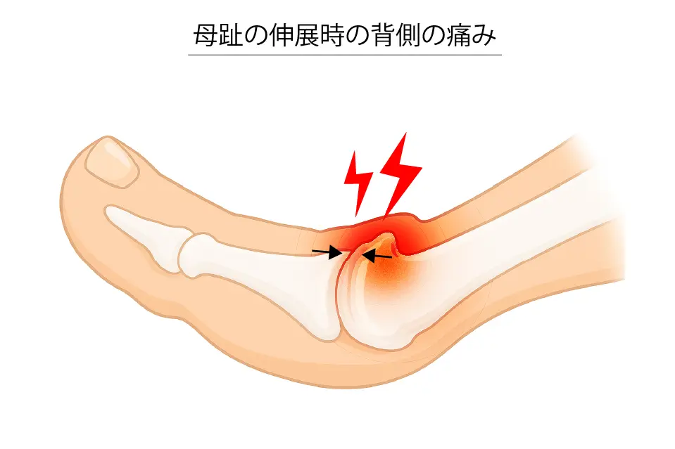 母趾伸展時の背側の痛み