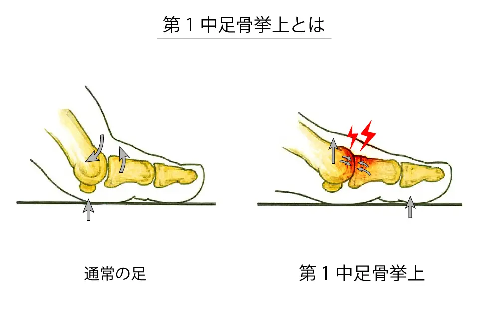 第1中足骨挙上