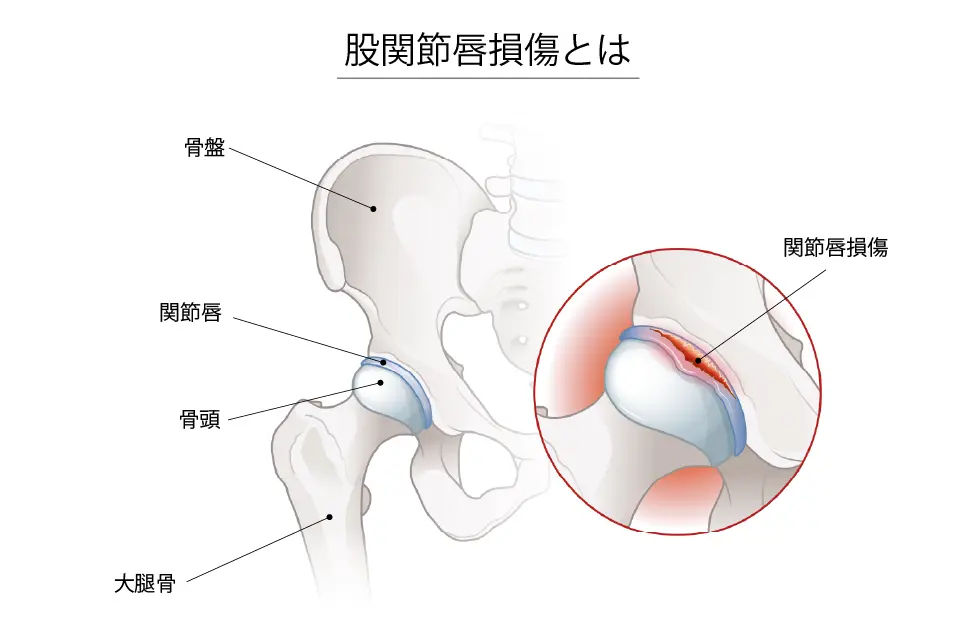 股関節唇損傷とは
