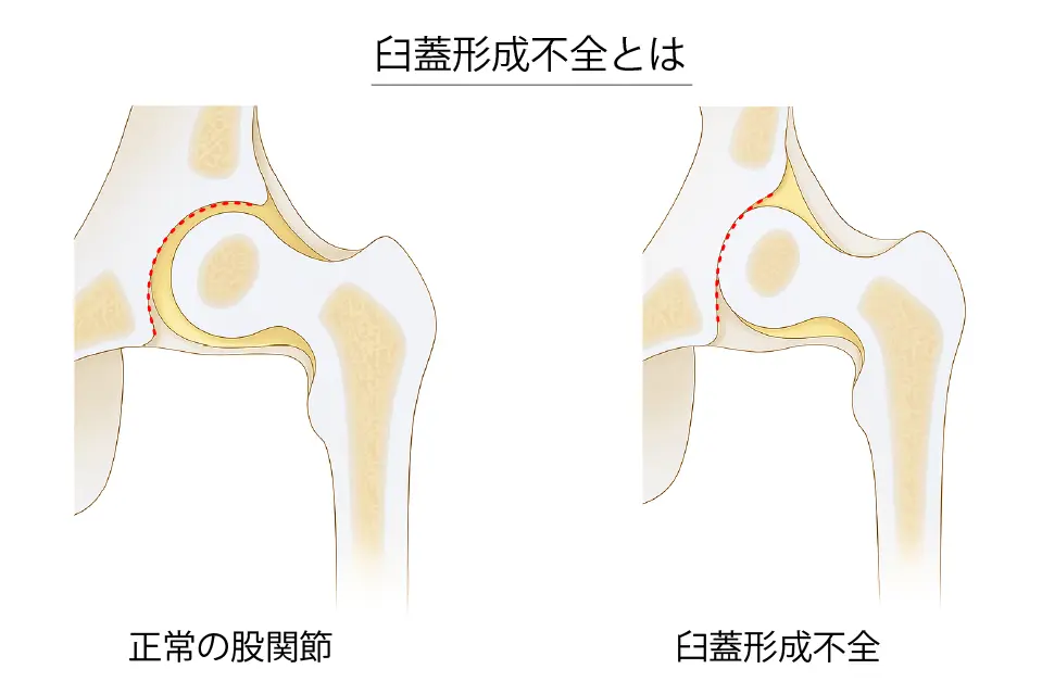 臼蓋形成不全とは