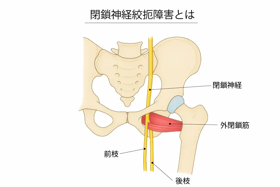 閉鎖神経障害とは
