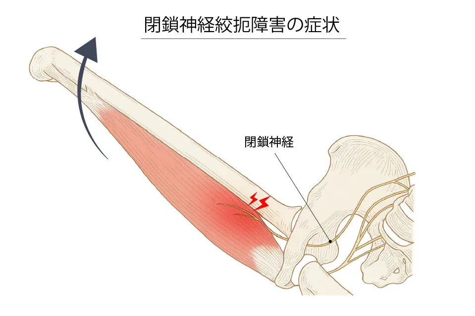 閉鎖神経障害の症状
