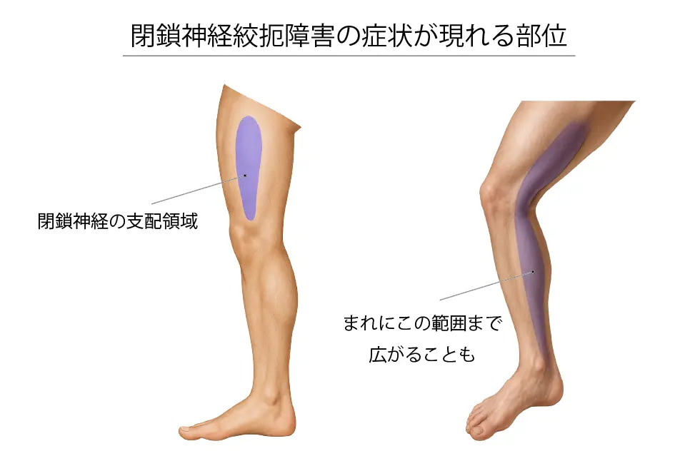 閉鎖神経障害の症状が現れる部位