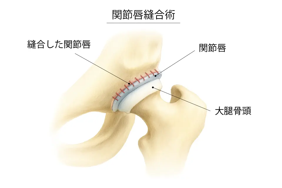 関節唇縫合術