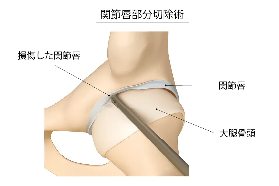関節唇部分切除術