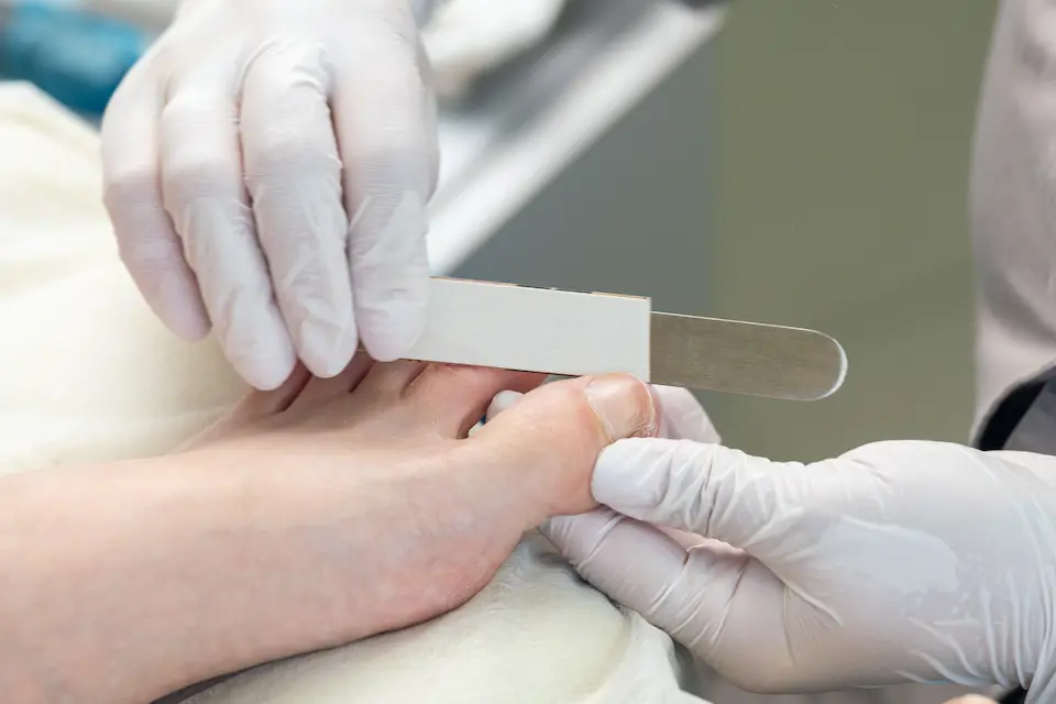 冬は痛みなく巻き爪の治療ができる