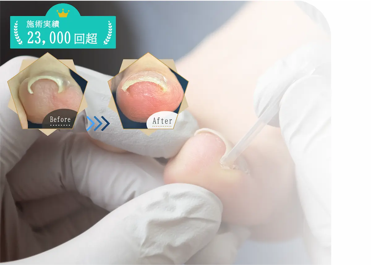 巻き爪FV（スマホ）