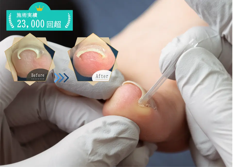 巻き爪FV（スマホ）２