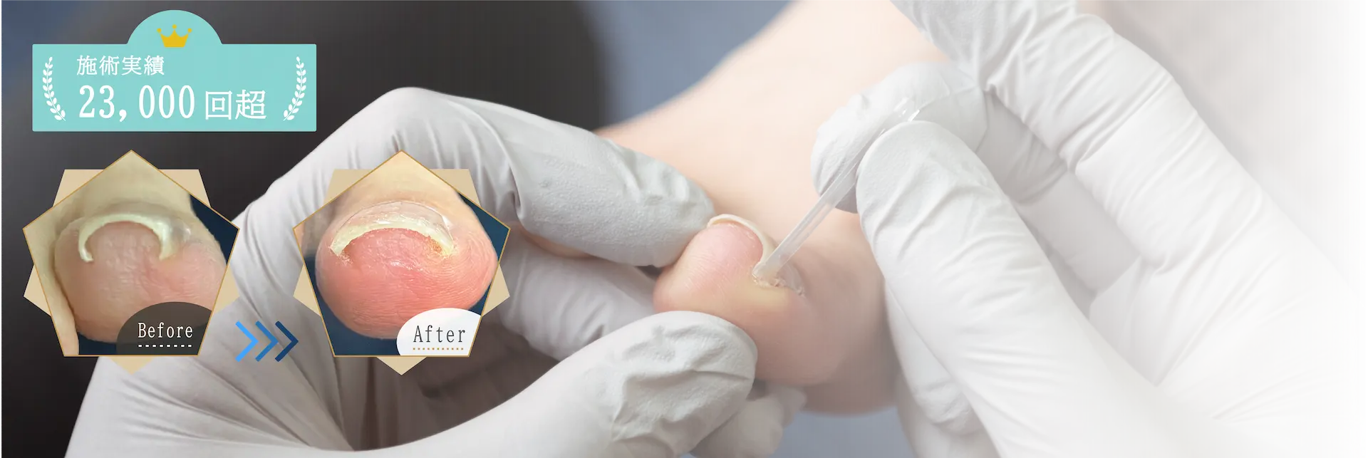 巻き爪治療FV(PC)