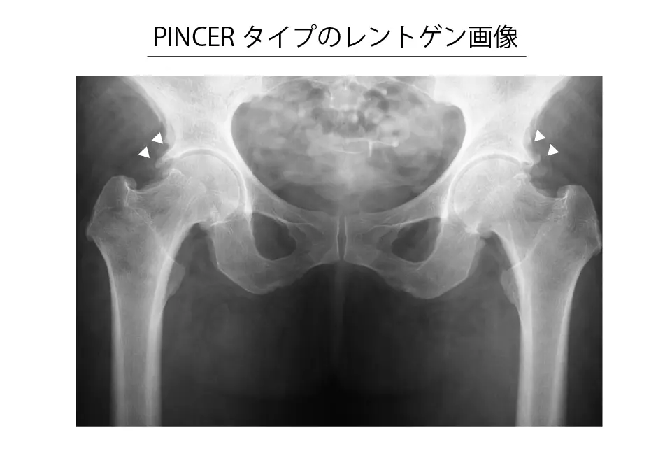 pincerタイプのレントゲン
