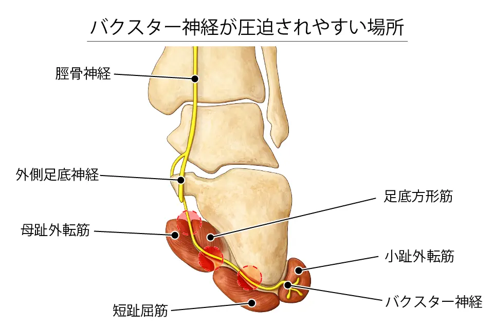 バクスター神経が圧迫されやすい場所