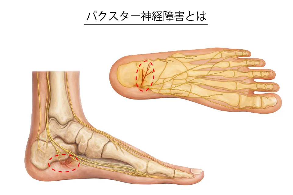 バクスター神経障害とは