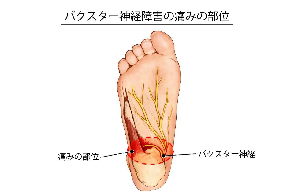 バクスター神経障害の痛みの部位