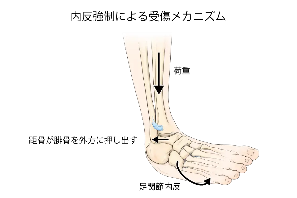 内反強制による受傷メカニズム