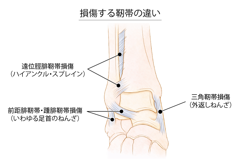 損傷する靭帯の違い