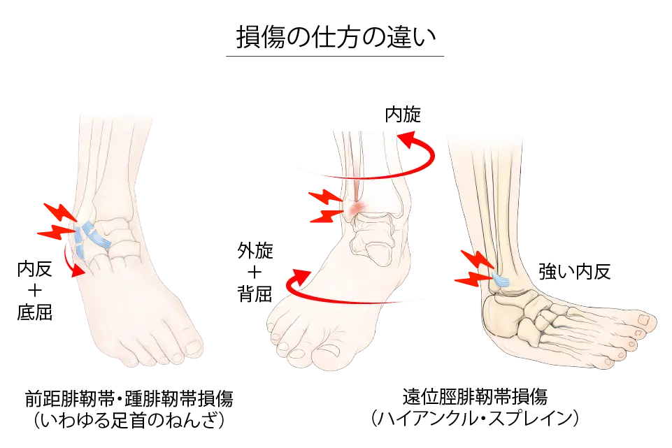 損傷の仕方の違い