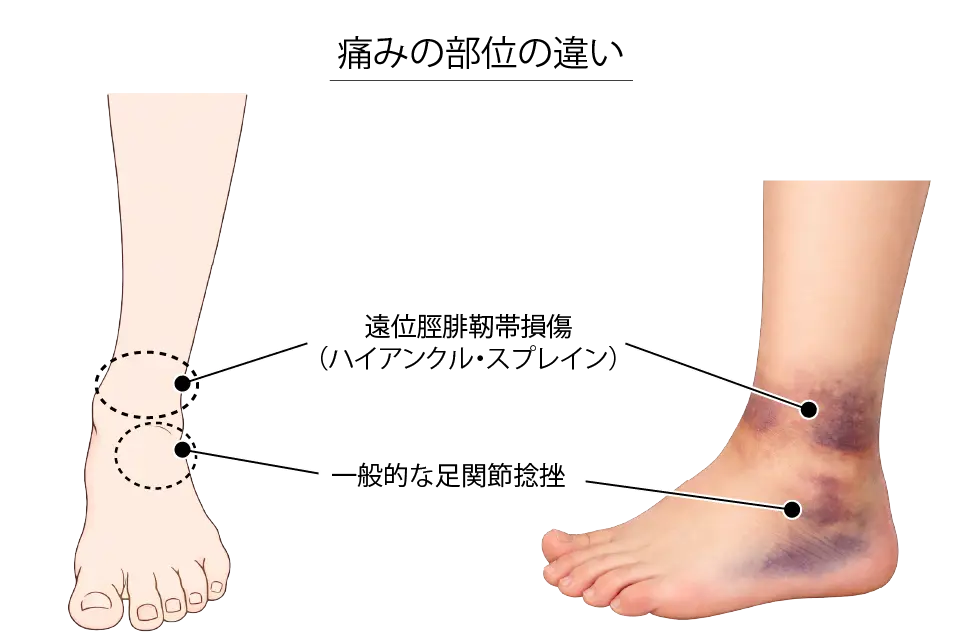 痛みの部位の違い