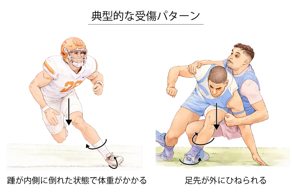 遠位脛腓靭帯の典型的な受傷パターン