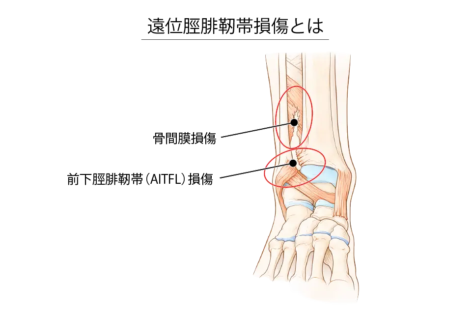 遠位脛腓靭帯損傷とは