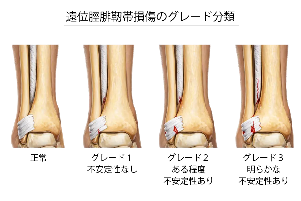 遠位脛腓靭帯損傷のグレード分類