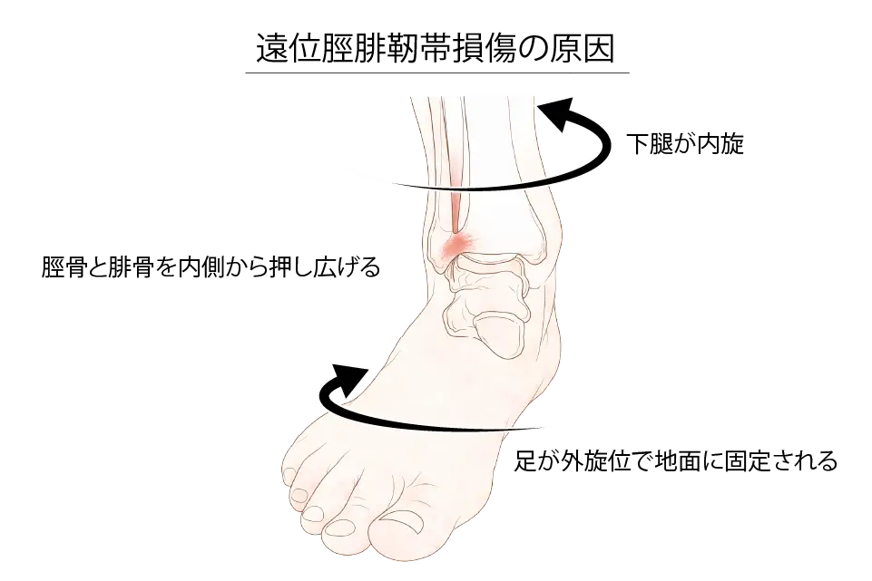 遠位脛腓靭帯損傷の原因