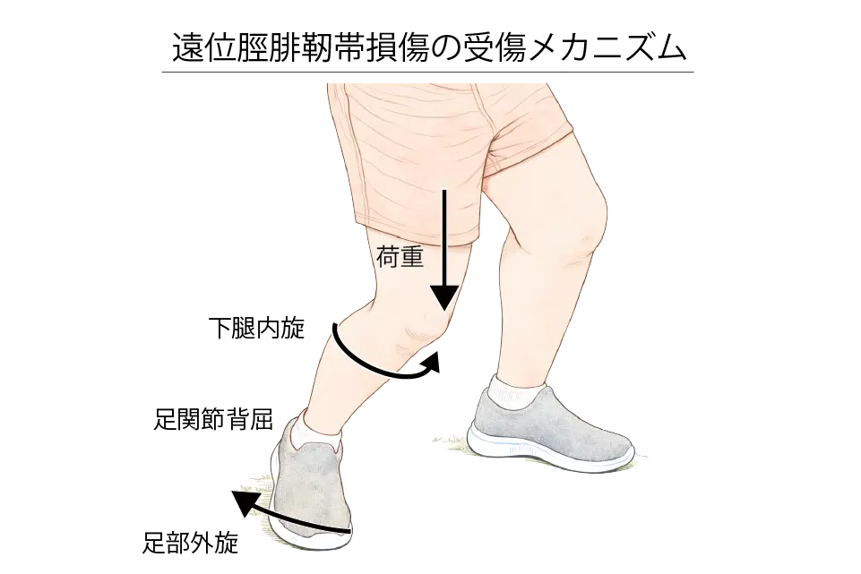 遠位脛腓靭帯損傷の受傷メカニズム