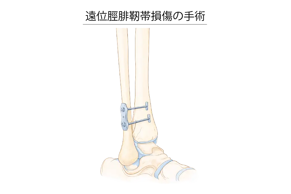 遠位脛腓靭帯損傷の手術