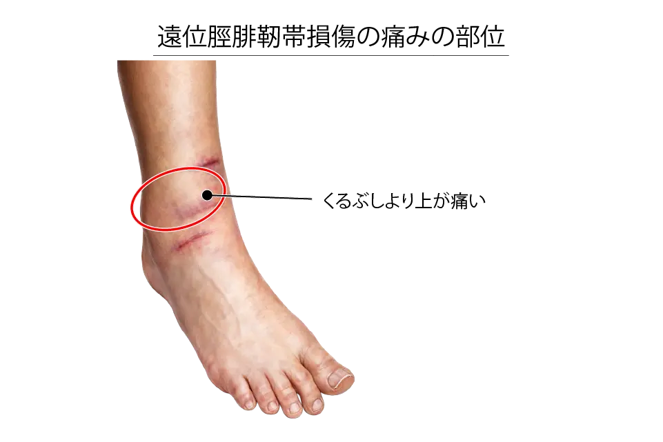 遠位脛腓靭帯損傷の症状