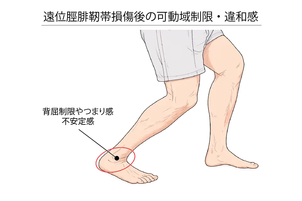 遠位脛腓靭帯損傷後の不安定感・背屈制限